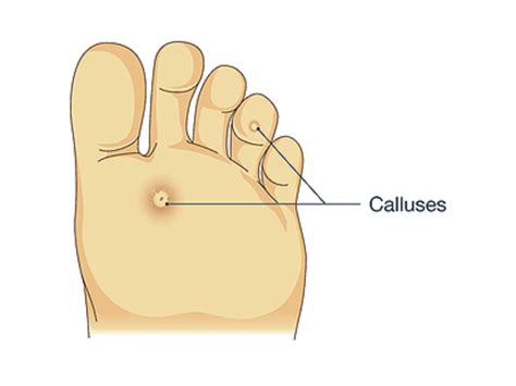 Callus Feet Under