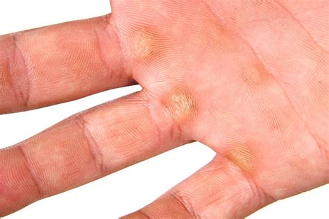 How to Effectively Remove a Callus on Hand Safely