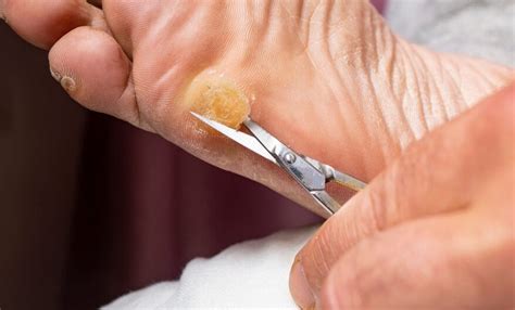 Callus Removal