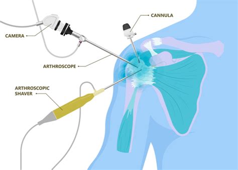Cam Shoulder Surgery