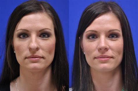 Everything You Need to Know About a NonSurgical Nose Job Slice