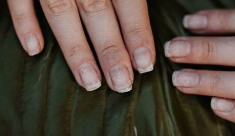 Acrylic Nail Injuries 7 Extraordinary Causes