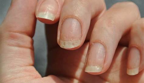 Can Acrylic Nails Cause Eczema Affect Your Fingernails? What You Need To