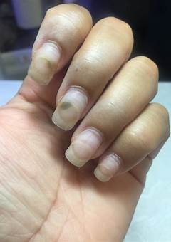 Can Acrylic Nails Cause Fungus?