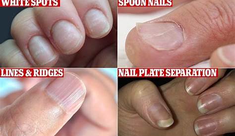 Acrylic Nail Injuries 7 Extraordinary Causes