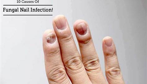 Can Acrylic Nails Cause Infections Model Shares Horrifying Images Of Infected Nail