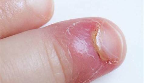 Can Acrylic Nails Cause Paronychia Acute And Chronic s Prevention & Treatment