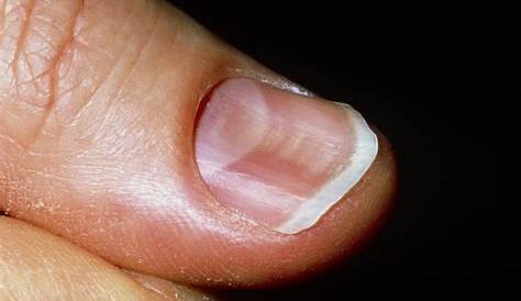 Acrylic Nail Injuries 7 Extraordinary Causes