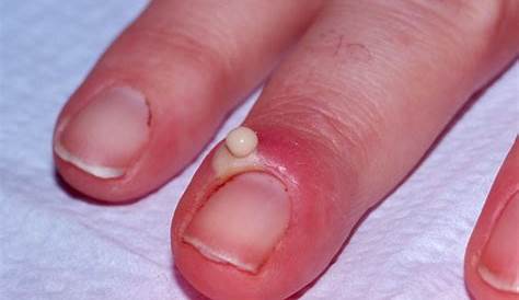 Can Acrylic Nails Cause Warts Periungual s Symptoms Treatment Prevention & More
