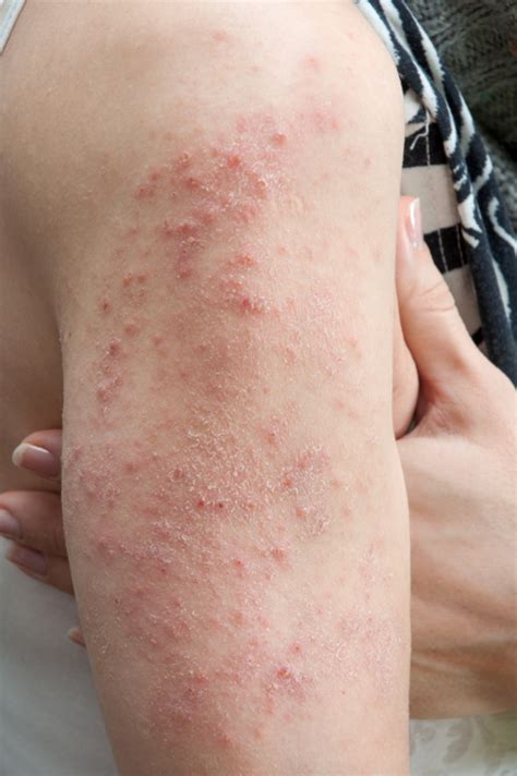 Want To Know About Hives? Take Care and Prevent It!! Drscabies