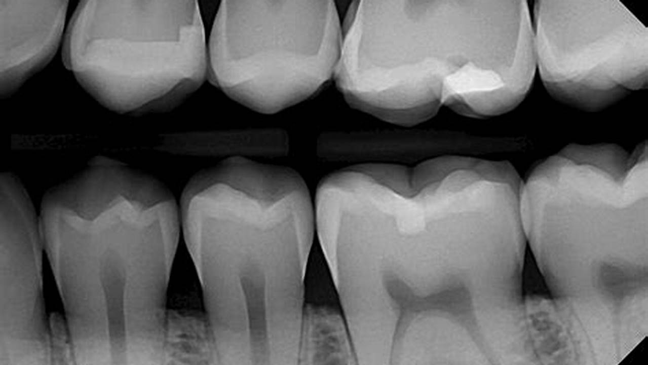 Uncover the Hidden Secrets: Detecting Minor Calculus on X-Rays for Optimal Dental Health