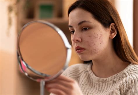 can depression cause acne
