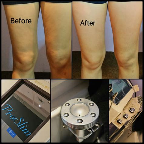 can ems help with cellulite
