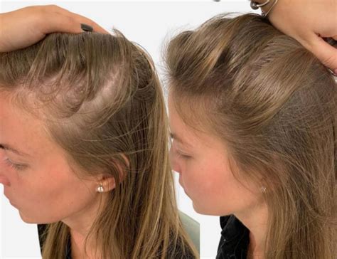 Hair Transplant Price in India Reviva Clinic Cost of