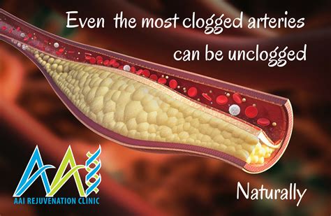 Clogged Arteries Symptoms, Causes and Treatment Scientific Animations
