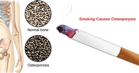 can smoking cause osteoporosis