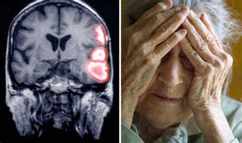 can stroke lead to dementia