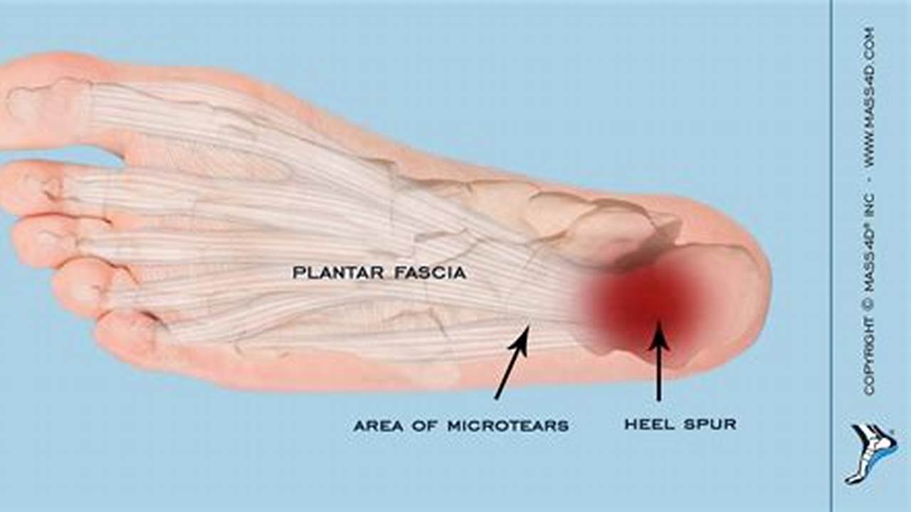 Can Tight IT Band Cause Plantar Fasciitis?