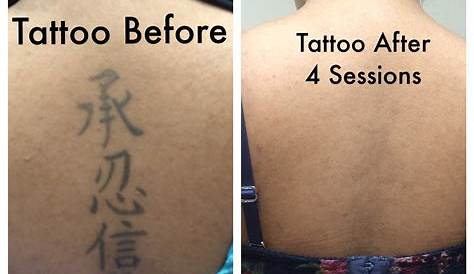 Can You Do Laser Tattoo Removal At Home What To Expect After