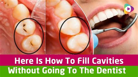 HERE IS HOW TO FILL CAVITIES WITHOUT GOING TO THE DENTIST! YouTube