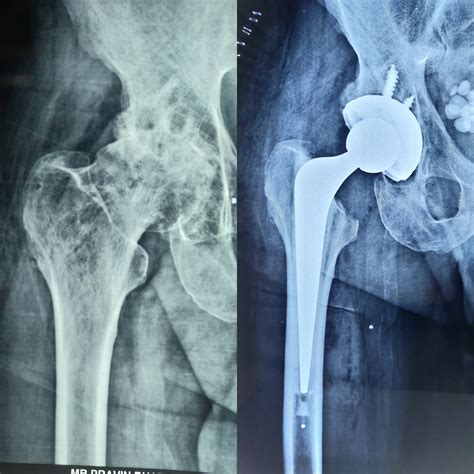 can you get a hip replacement if you have osteoporosis