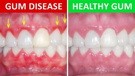 What is gingivitis? Ask Your Dentist