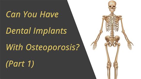 can you have dental implants if you have osteoporosis