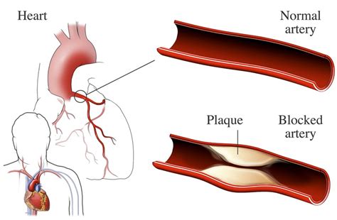  27 References Can You Live With A Blocked Coronary Artery Update Now