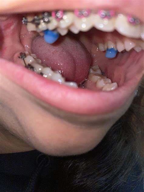 Can't Eat With Bite Blocks