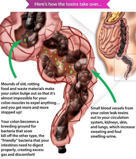 Can A Bad Back Affect Your Bowels
