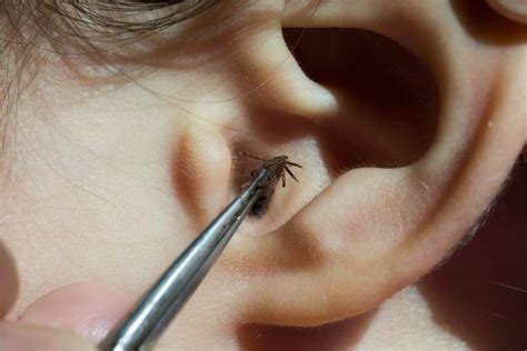 Can A Bug Fly Into Your Ear And Get Stuck