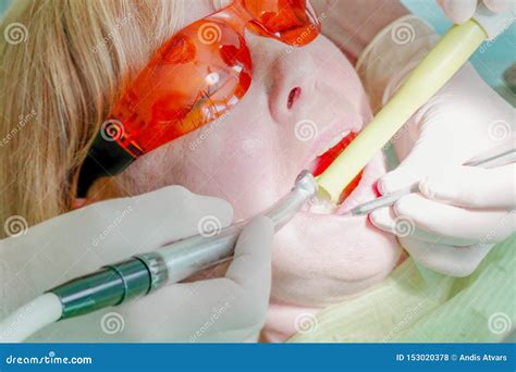 Can A Dentist Remove Cavities