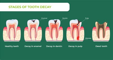 A decayed tooth can only be treated by a dentist! Teeth are incapable