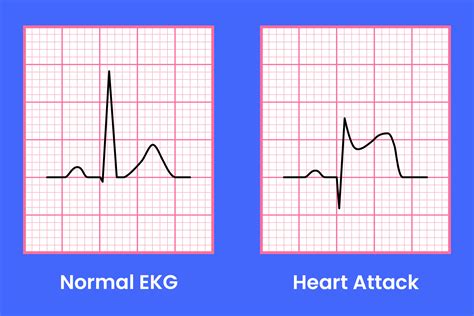 can a ecg detect heart failure