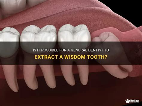Wisdom Tooth Extractions Mount Pleasant Medical & Dental Centre