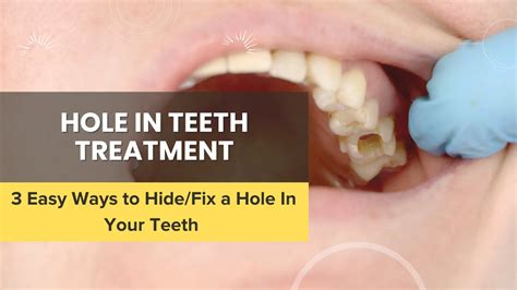 can a hole in a tooth be fixed