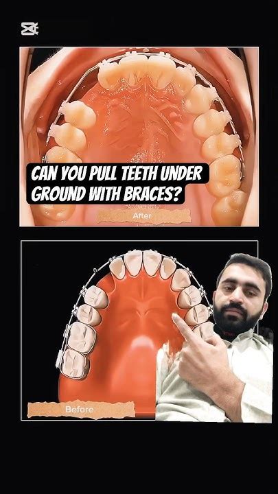 Can A Orthodontist Pull Teeth