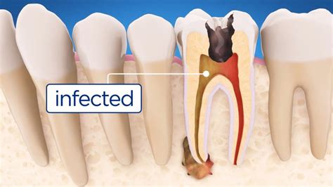 ftn.rocasa.us:can a regular dentist do a root canal