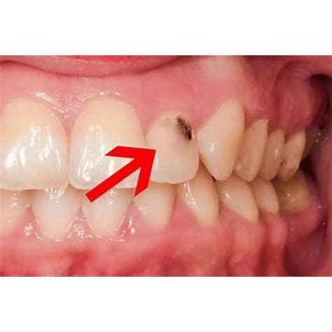 can a tooth with a hole in the side be saved