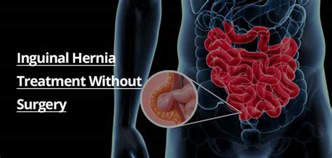 can an inguinal hernia cause stomach pain