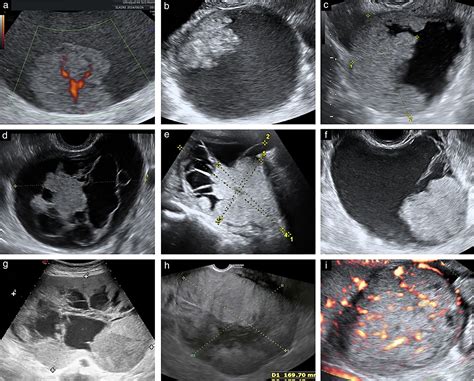 can an ultrasound detect ovarian cancer