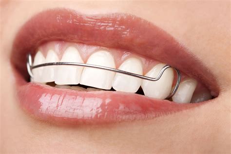 Dentist Holding Retainer For Teeth Stock Photo Image of care, cure