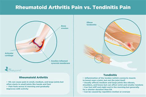 Can Arthritis Cause Tendon Problems