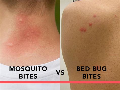 Can Bed Bug Bites Be Singular