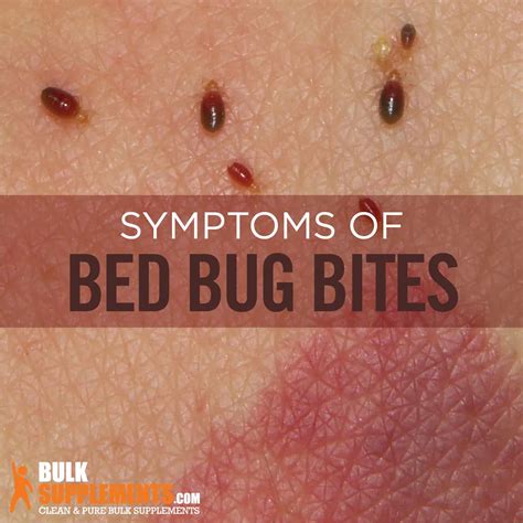 Can Bed Bugs Bite Your Ear