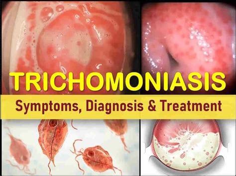 Can Bed Bugs Cause Trichomoniasis