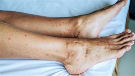 Can Bed Bugs Only Bite Legs