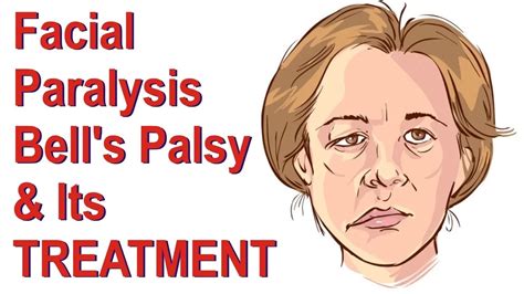 can bell's palsy come and go