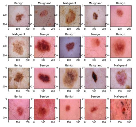 can blood test detect melanoma