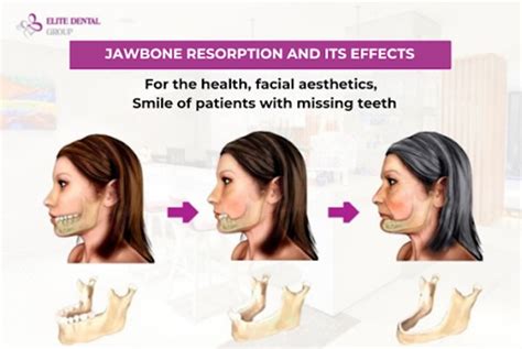 Can Bone Loss Grow Back